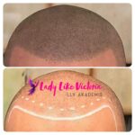 Scalp Pigmentierung